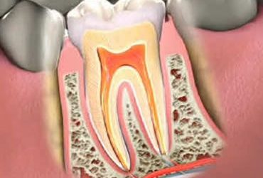 Should an Endodontist Perform Your Root Canal Treatment?