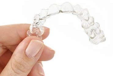 Invisalign: A Modern Way to Improve your Smile