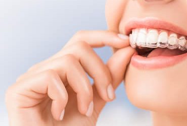 Keep Your Mouth Healthier by Choosing Invisalign Over Traditional Braces