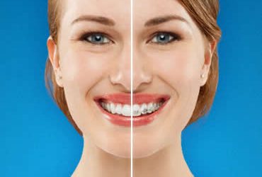 Why Adults Should Choose Invisalign to Straighten Teeth